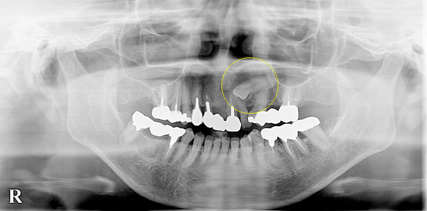 インプラントなどの埋伏歯（まいふくし） | 旭川 ヒロ歯科・口腔外科 