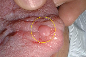 舌先の線維腫