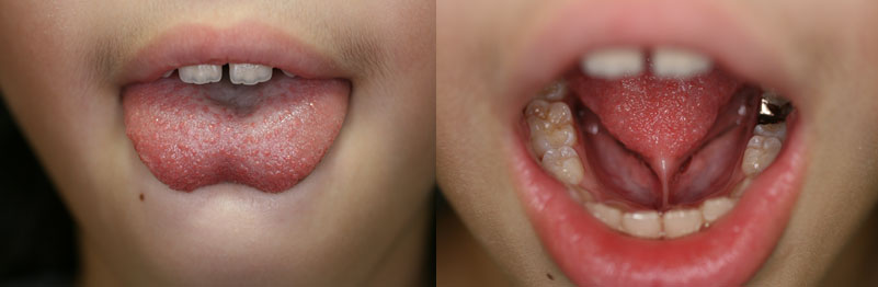 舌小帯異常術前