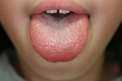 舌小帯異常術後